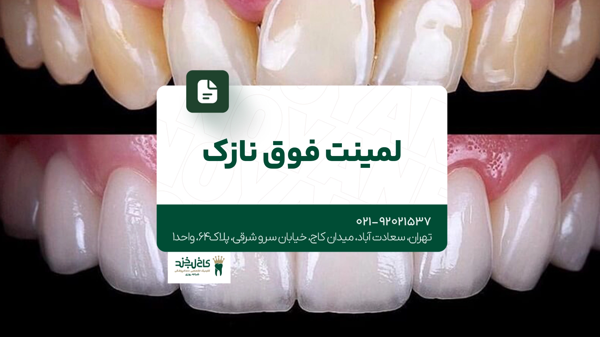 لمینت فوق نازک