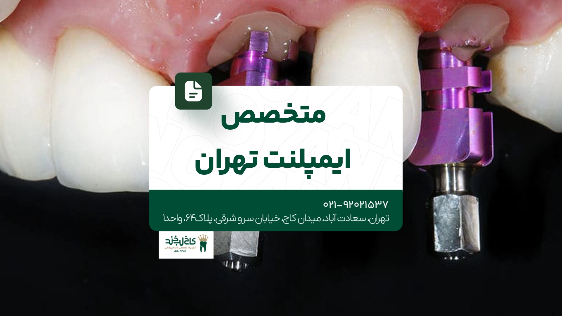 متخصص ایمپلنت تهران متخصص ایمپلنت تهران