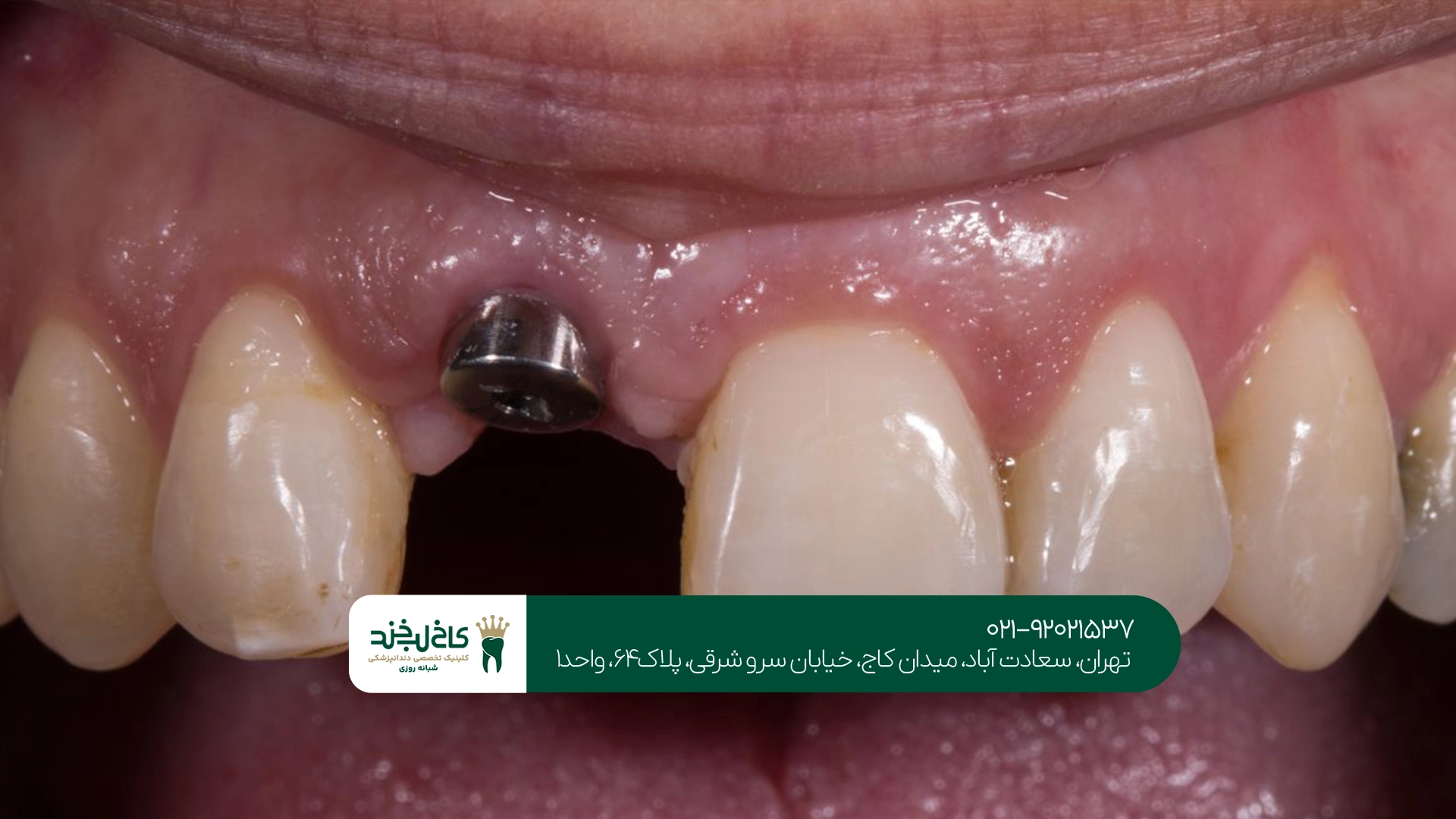 ایمپلنت دندان در تهران ایمپلنت دندان در تهران