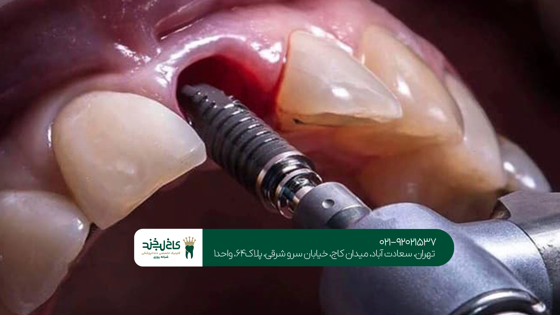 بهترین متخصص ایمپلنت تهران بهترین متخصص ایمپلنت تهران