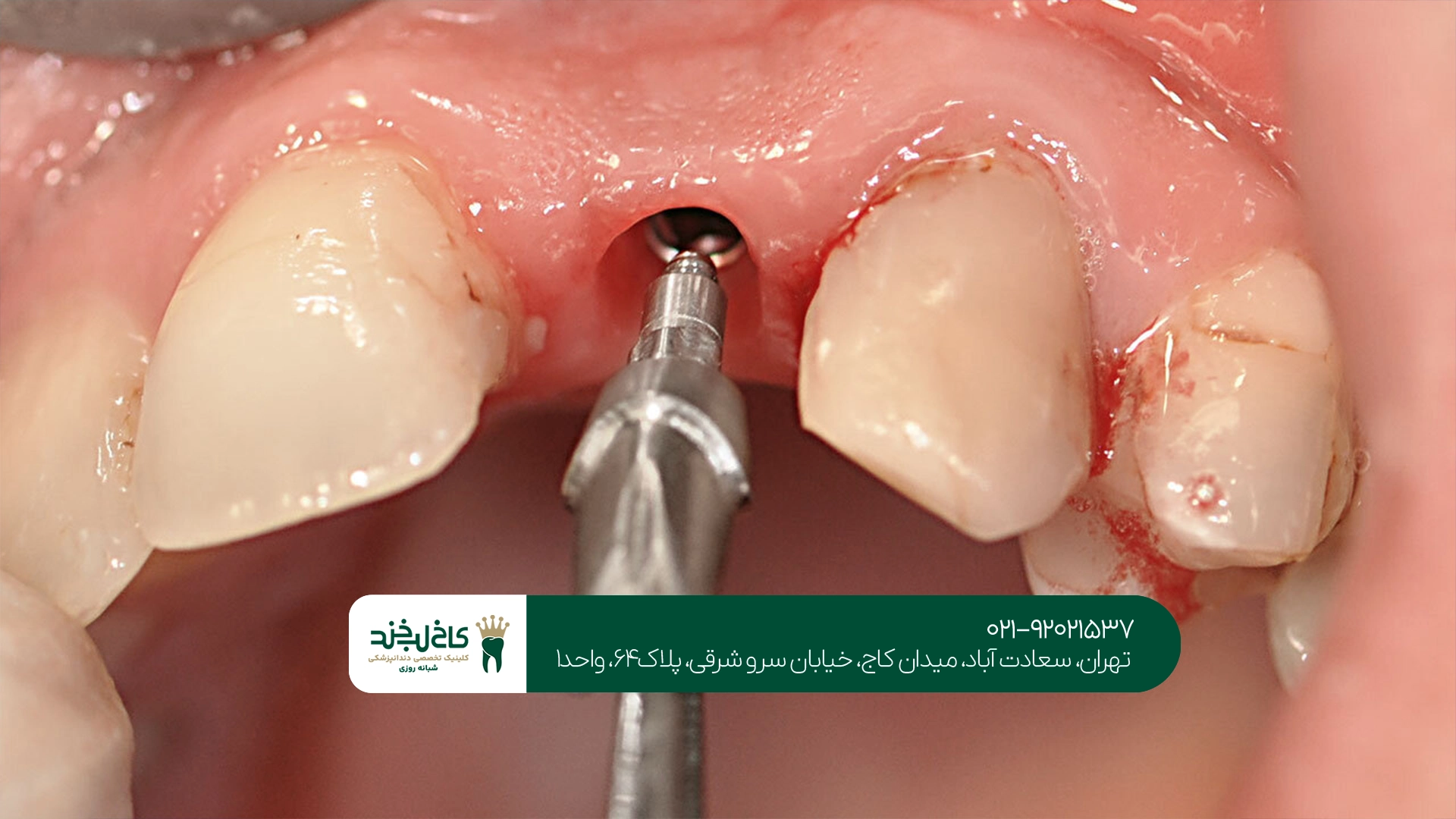 بهترین متخصص ایمپلنت در تهران بهترین متخصص ایمپلنت در تهران