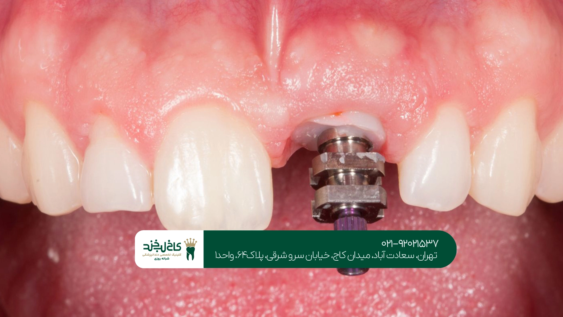 متخصص ایمپلنت دندان متخصص ایمپلنت دندان