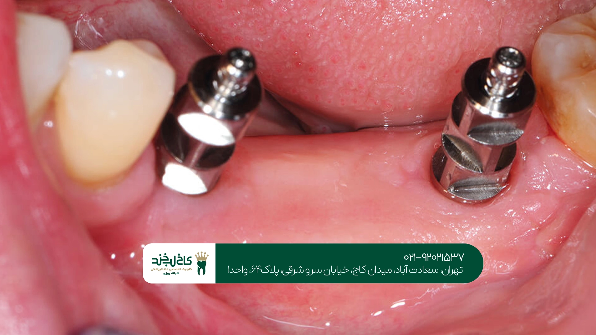 بهترین متخصص ایمپلنت سعادت آباد بهترین متخصص ایمپلنت سعادت آباد