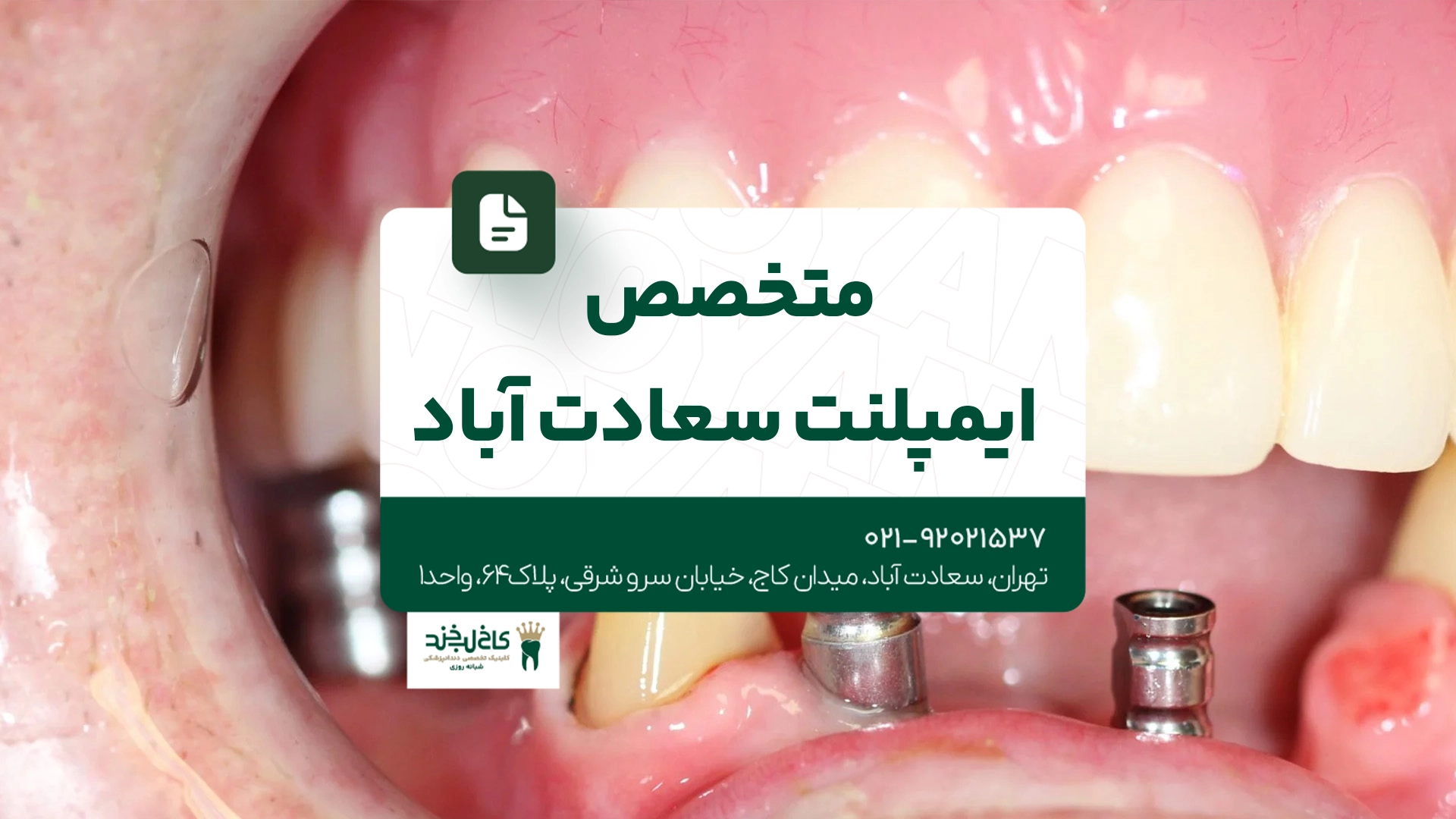 متخصص ایمپلنت سعادت آباد متخصص ایمپلنت سعادت آباد