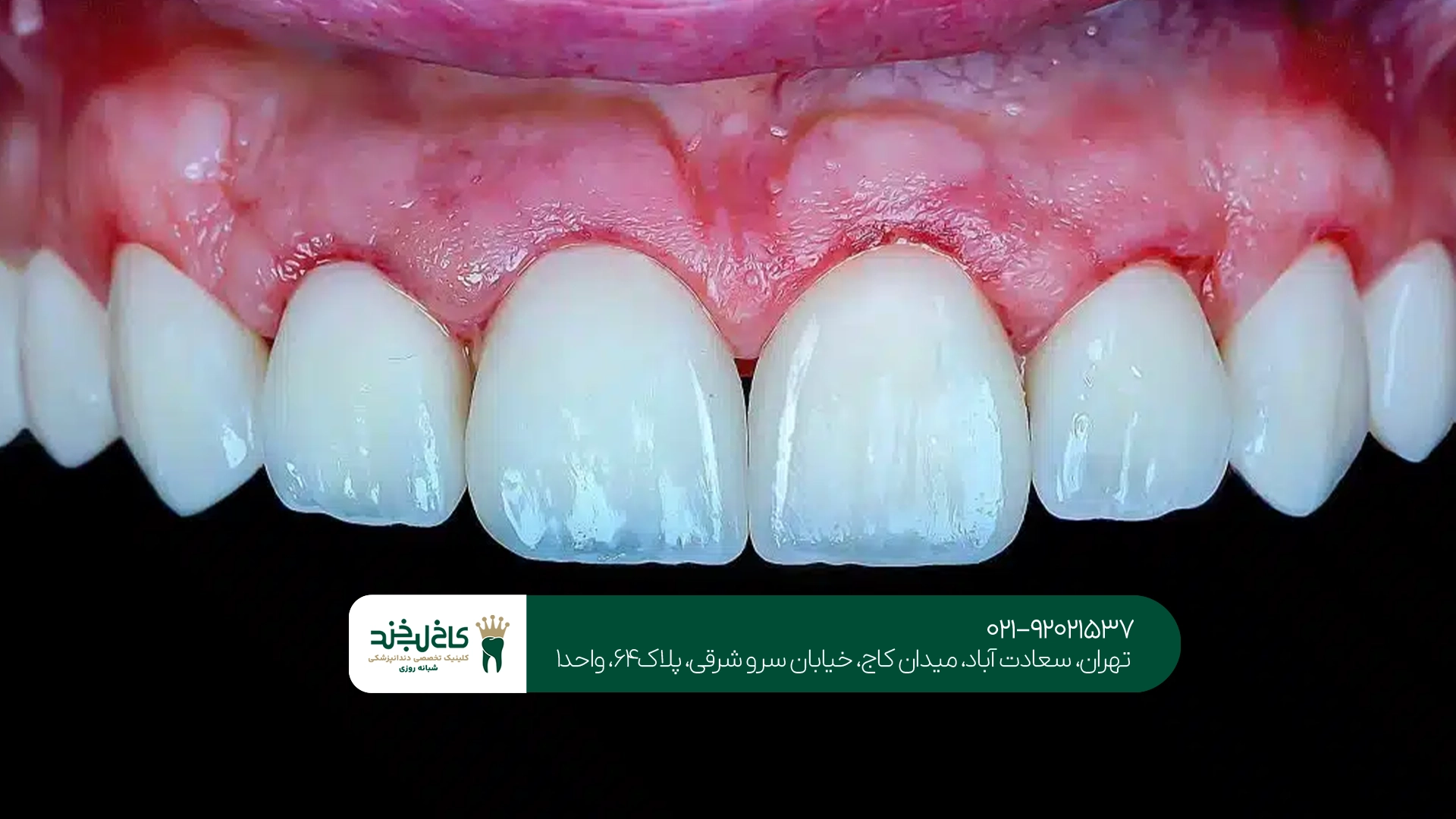 لمینت دندان در تهران