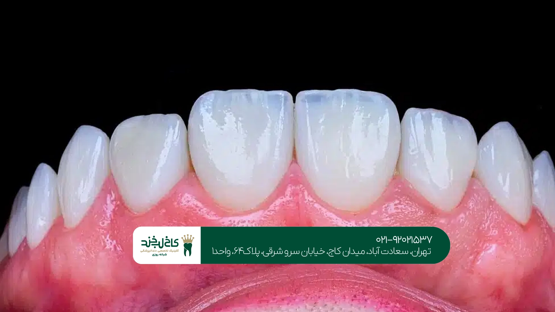 لمینت دندان تخصصی