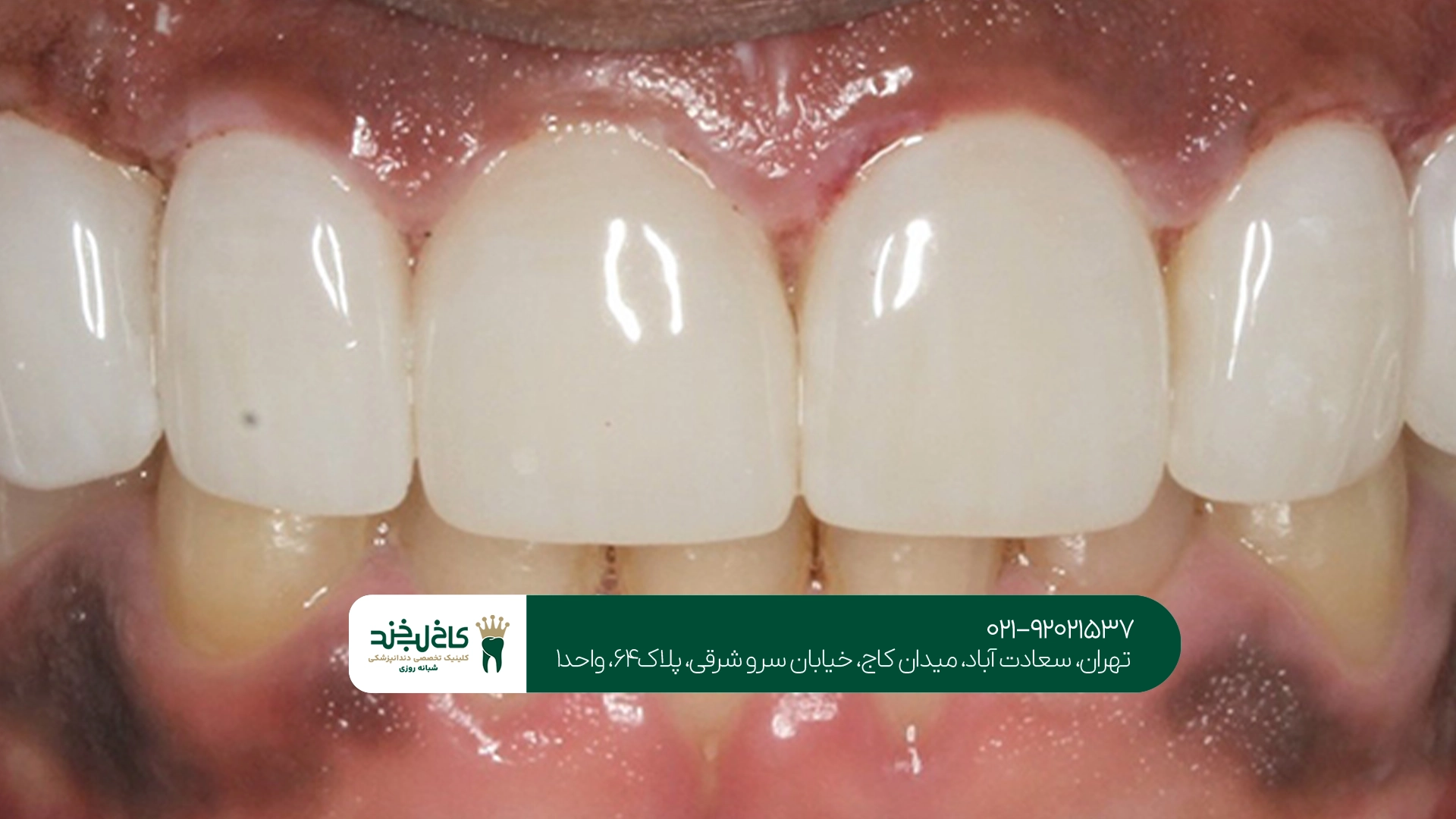 لمینت دندان توسط متخصص چگونه انجام میشود؟