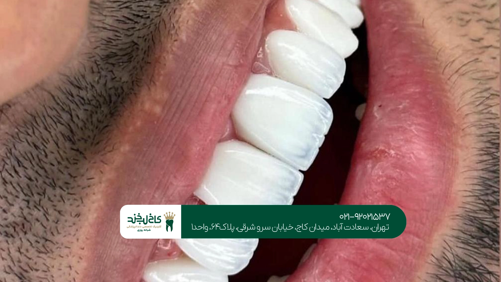 برای انتخاب متخصص کامپوزیت دندان تهران به چه نکاتی توجه کنیم؟