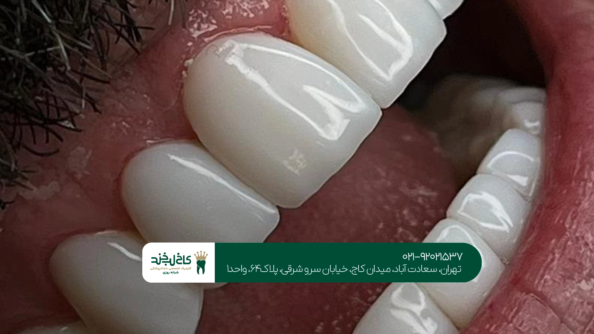 بهترین متخصص کامپوزیت دندان تهران