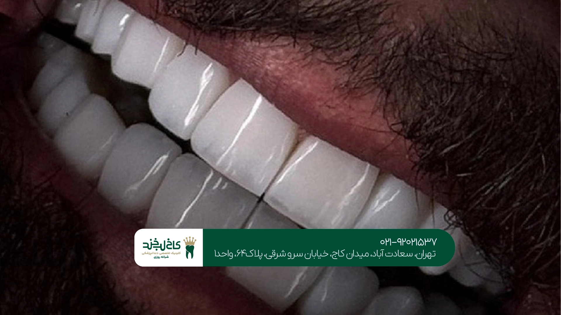 مرکز تخصصی کامپوزیت دندان تهران