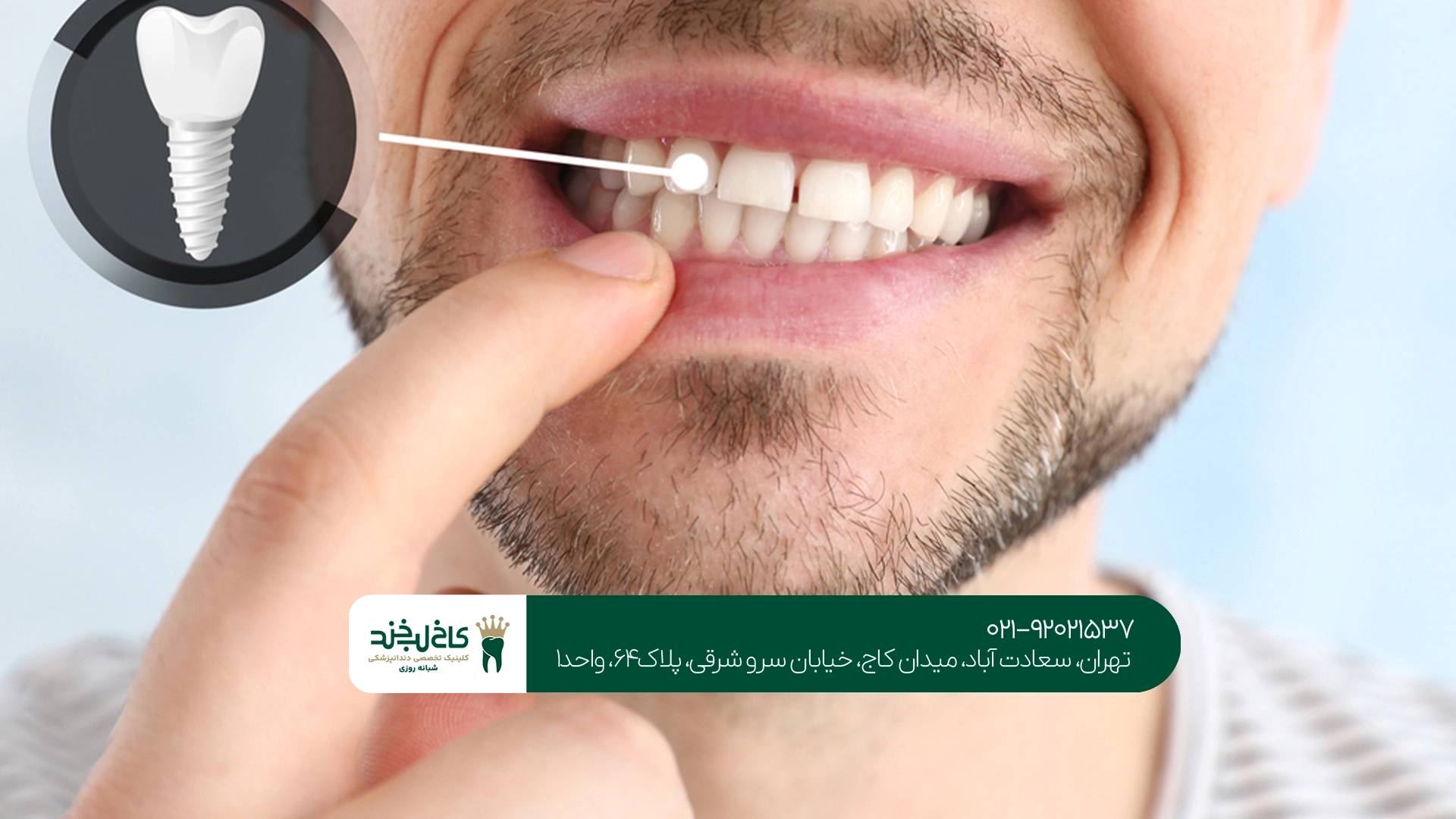 چه عواملی در موفقیت درمان ایمپلنت دندان مؤثر هستند؟