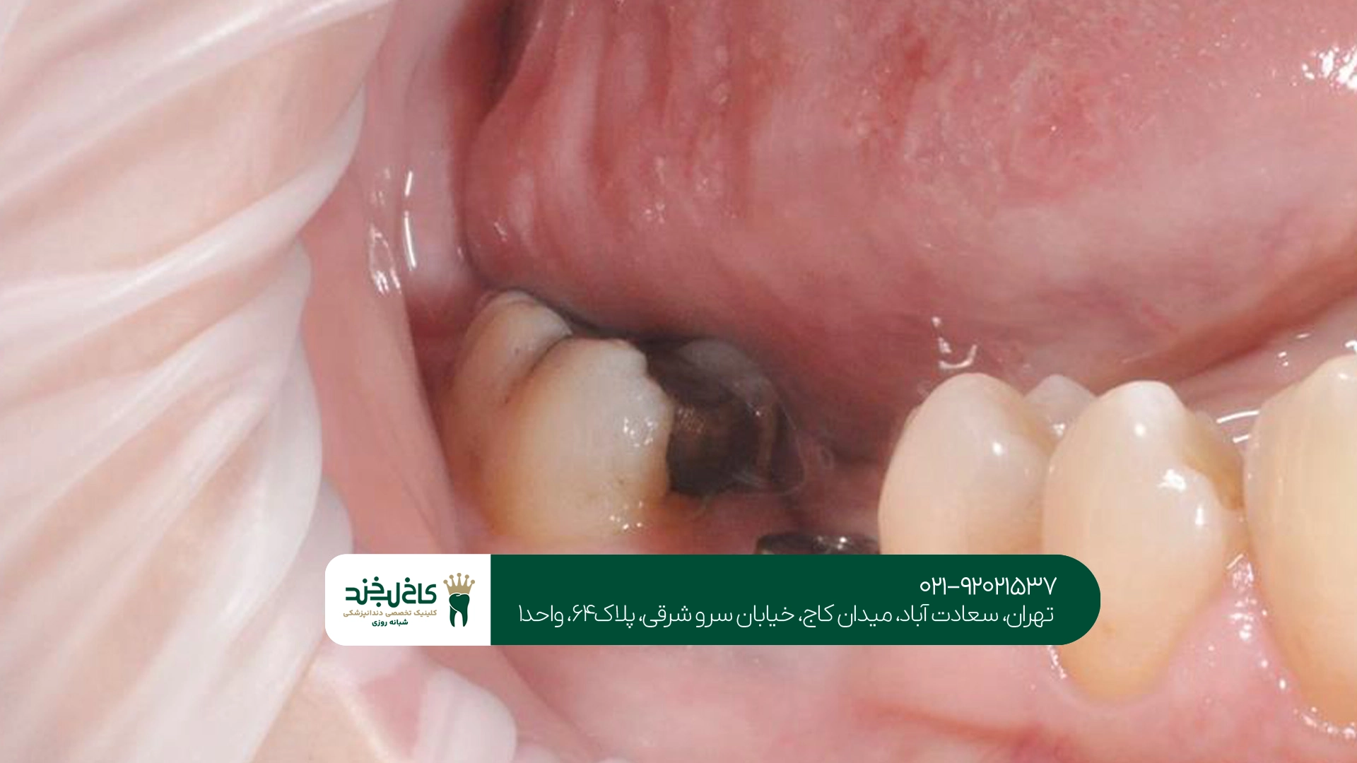 مرکز تخصصی کاشت ایمپلنت دندان