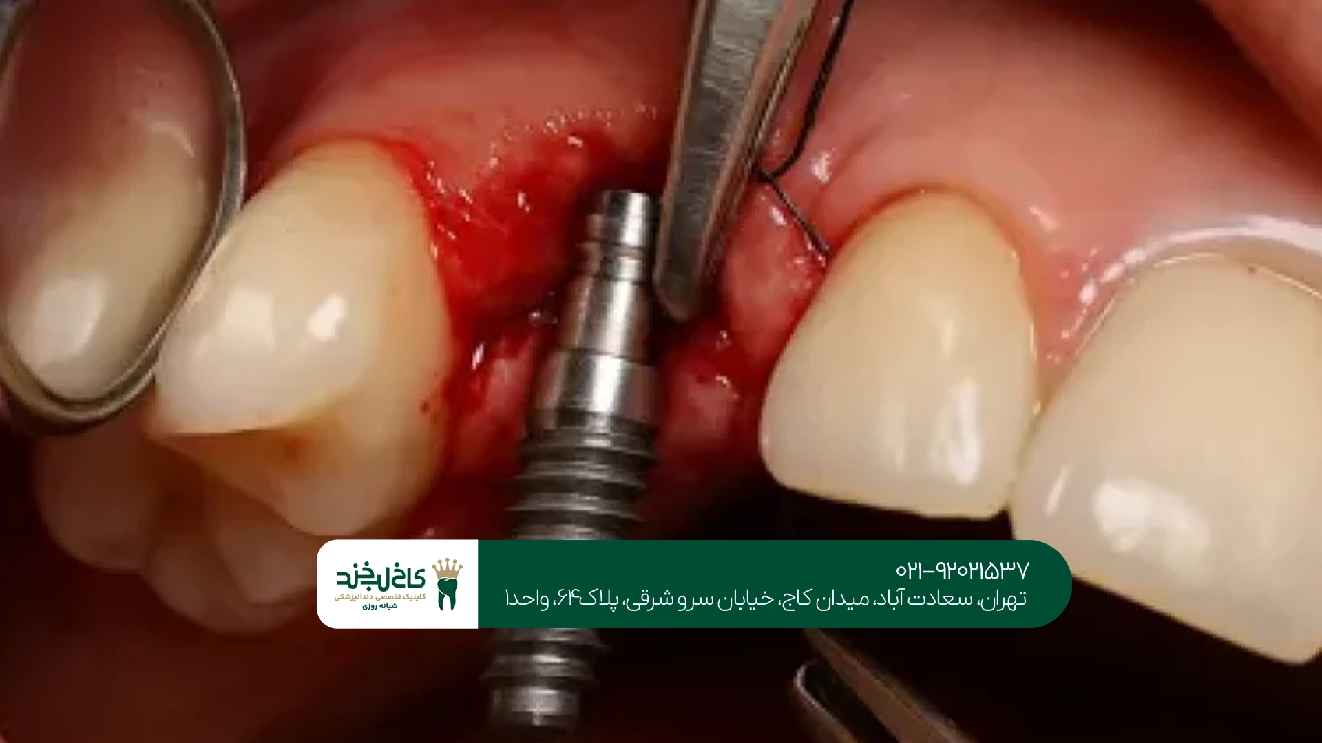 هزینه انواع ایمپلنت دندان در تهران