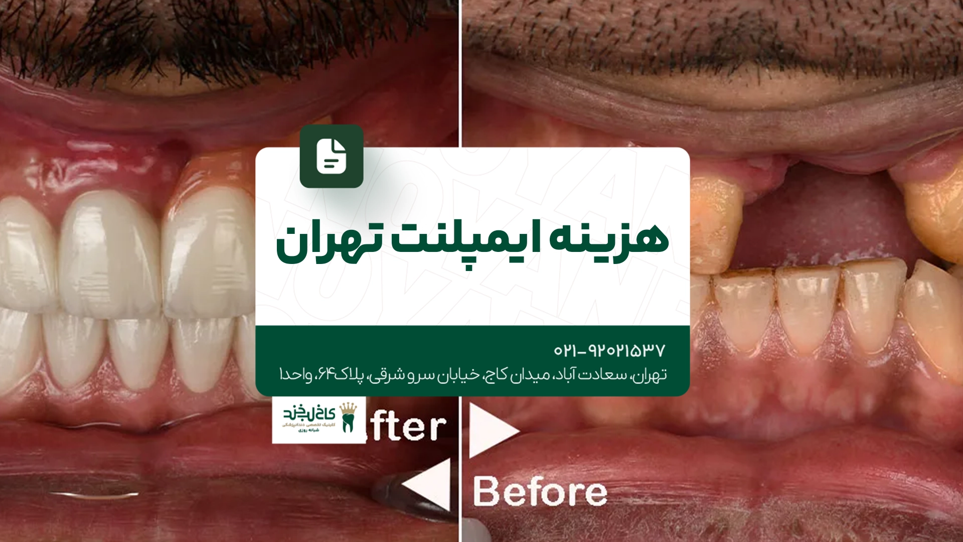 هزینه ایمپلنت تهران