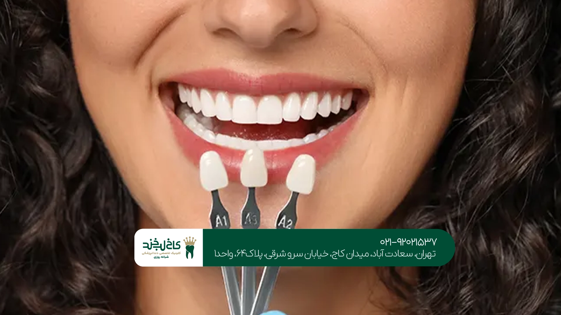مرکز لمینت سرامیکی در تهران
