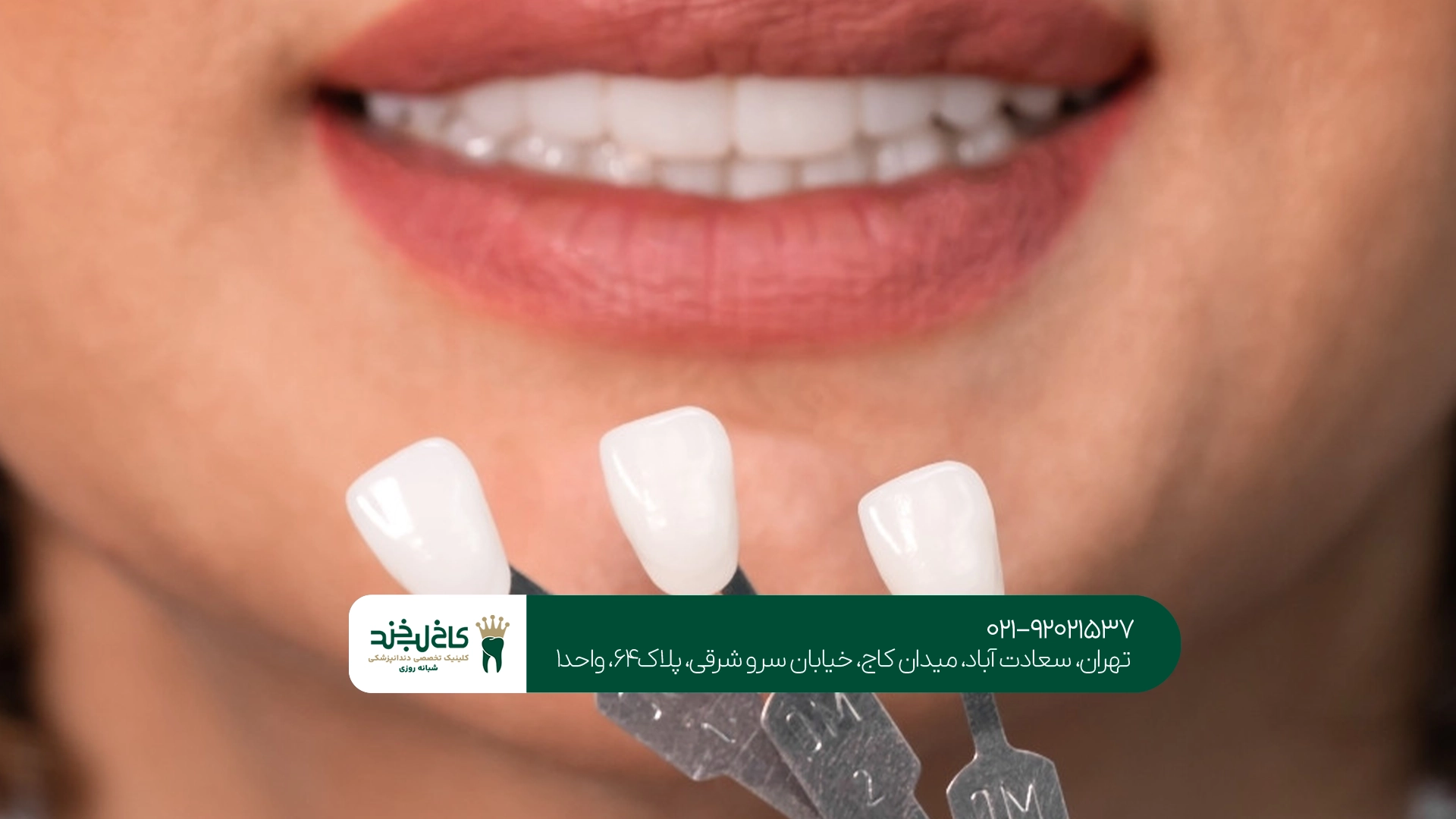 تفاوت قیمت انواع لمینت سرامیکی چیست؟