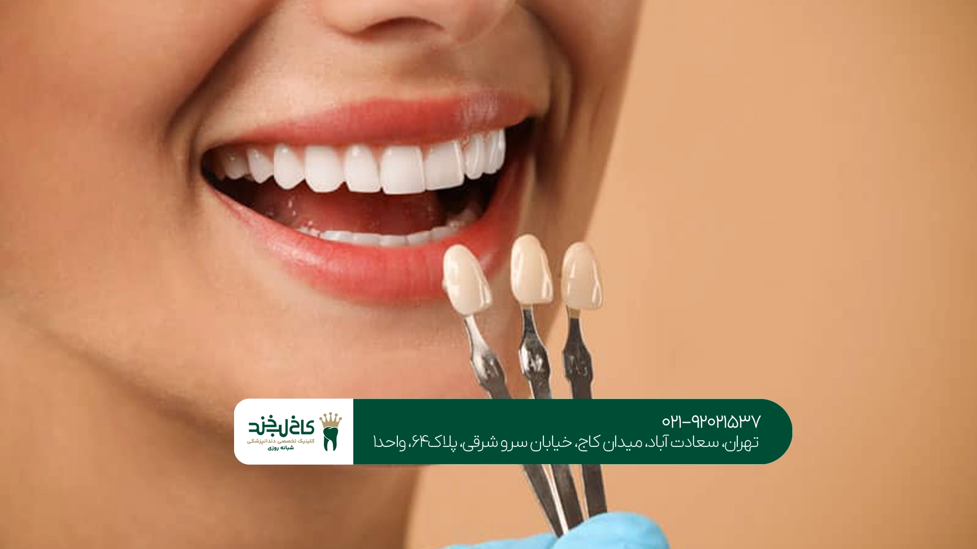 هزینه هر واحد لمینت سرامیکی چگونه محاسبه میشود؟