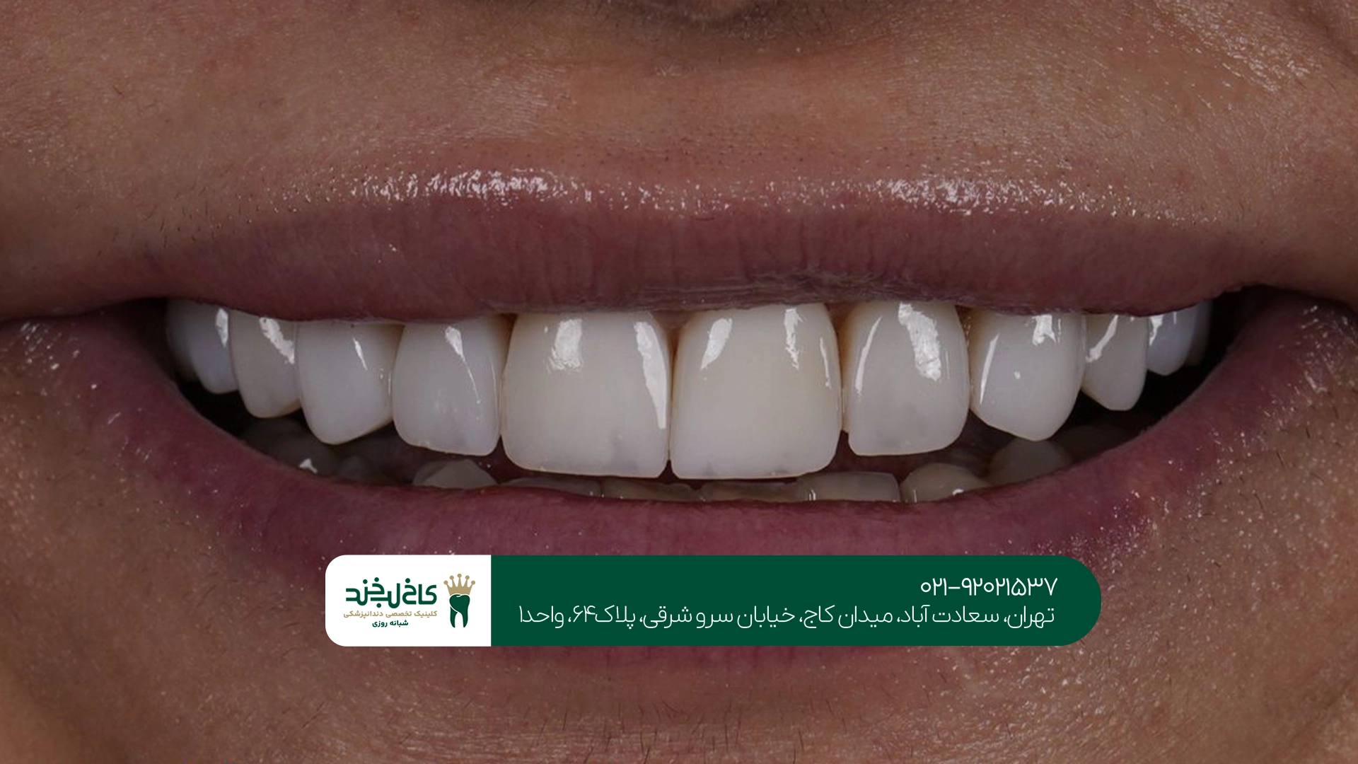 کلینیک ونیر سرامیکی دندانهای جلو