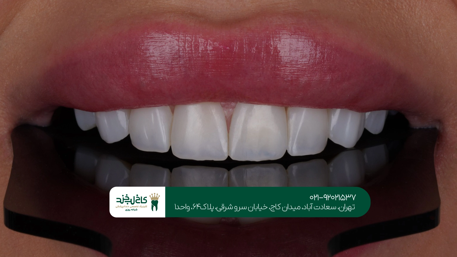 بهترین کلینیک ونیر سرامیکی تهران کجاست؟