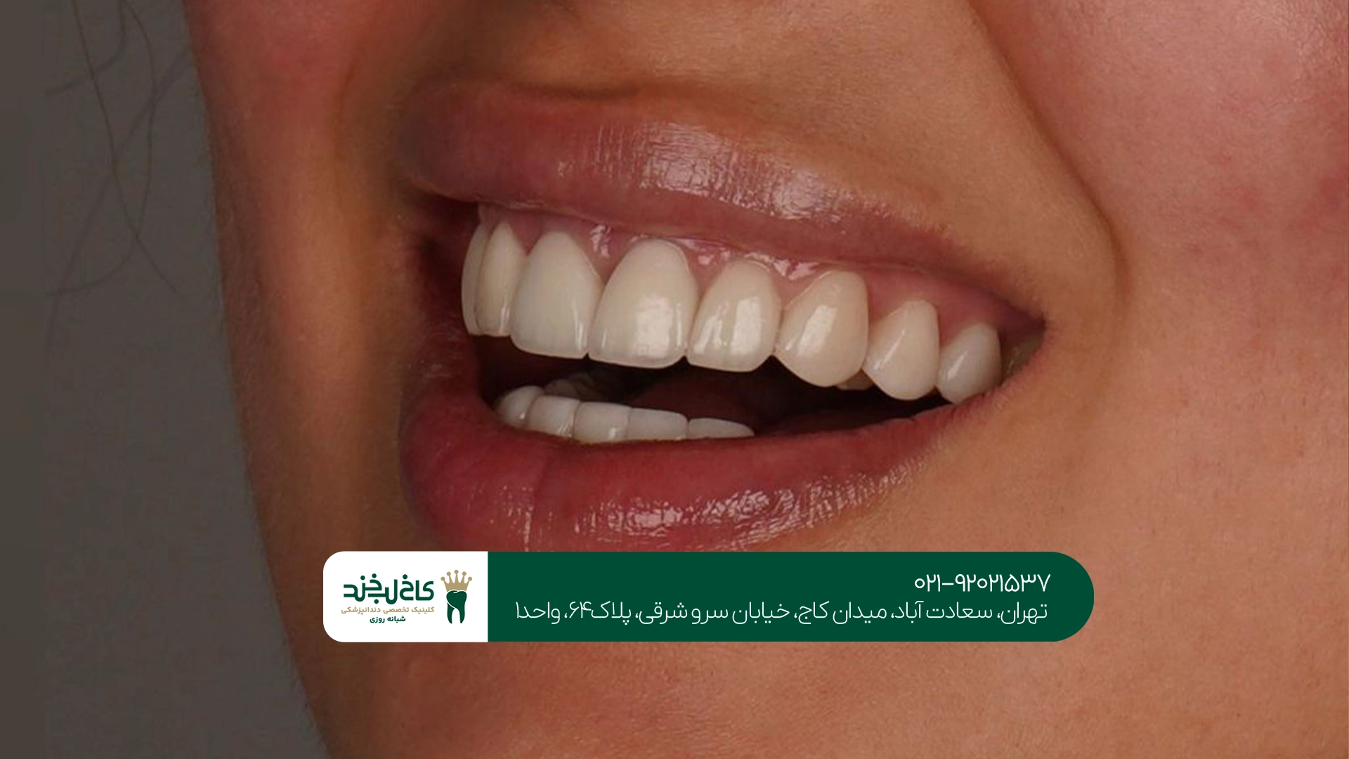 ونیر سرامیکی چقدر ماندگاری دارد؟
