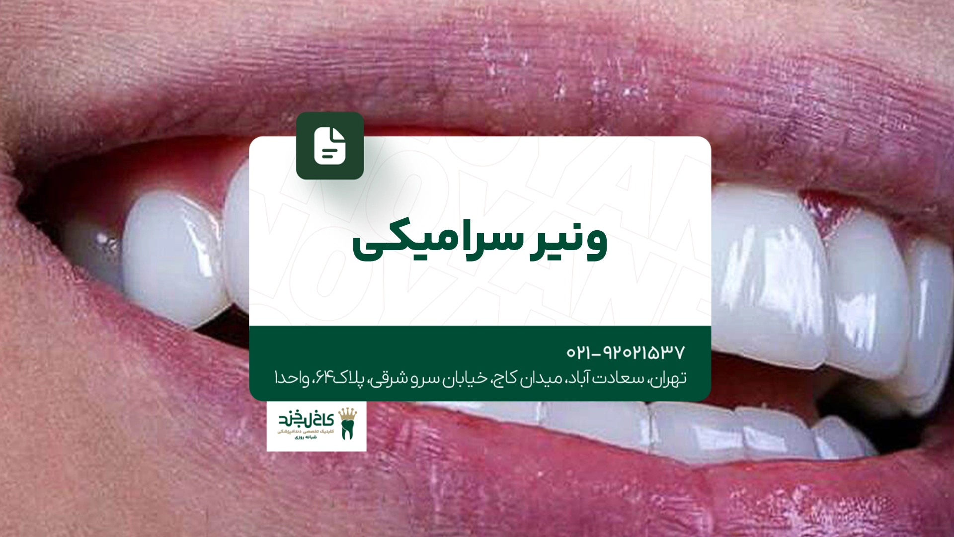 ونیر سرامیکی