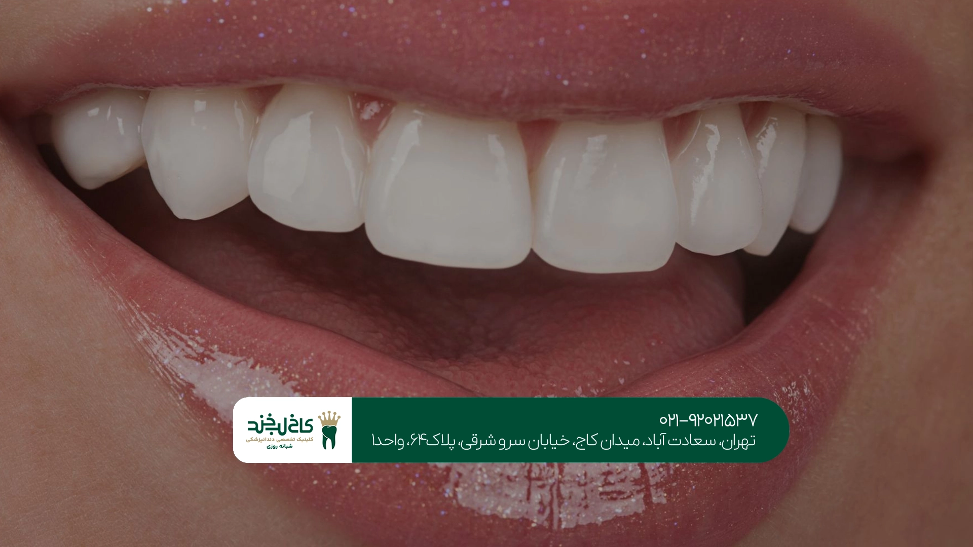 ونیر کامپوزیت برای دندانهای فاصلهدار