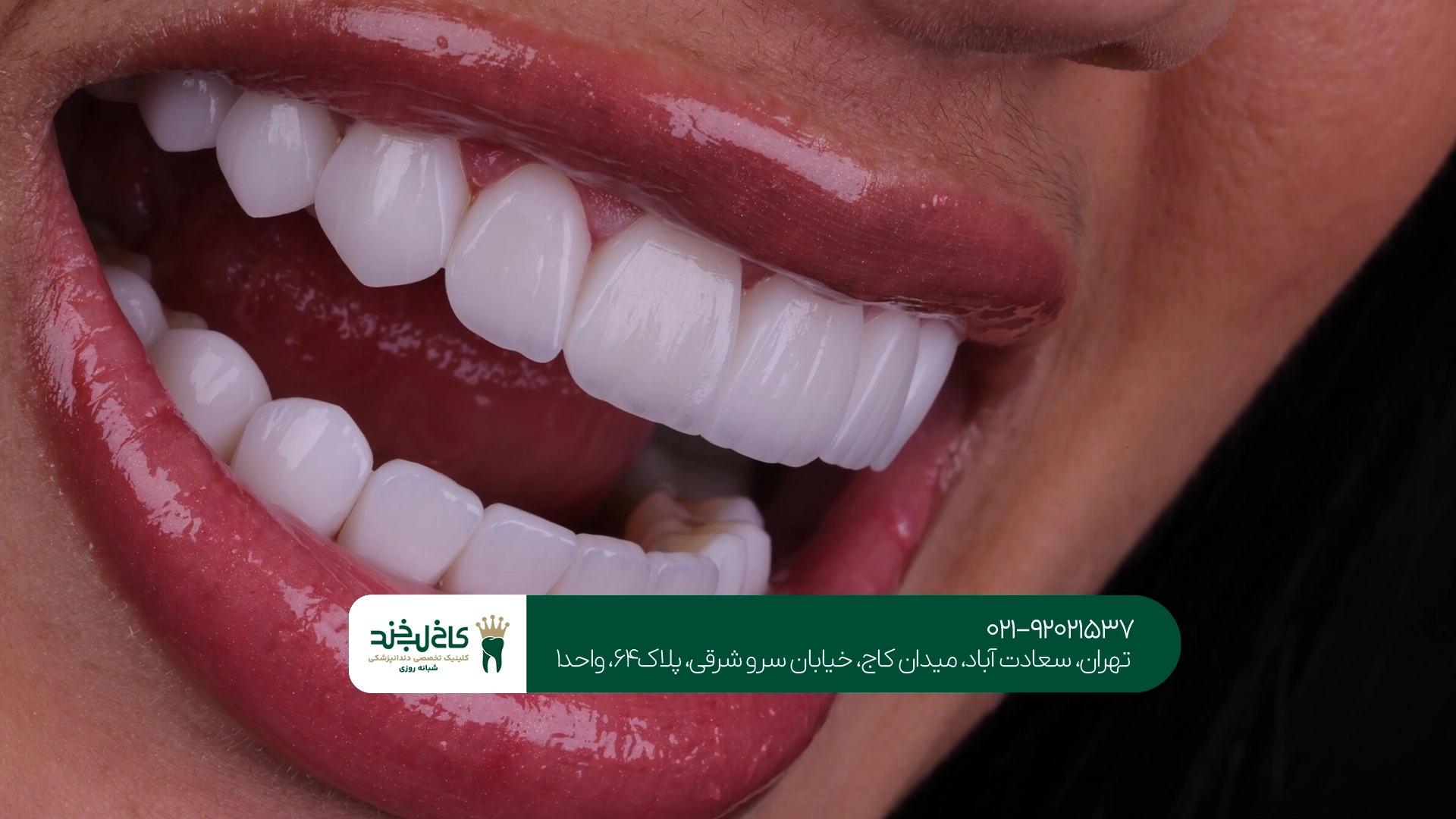 تفاوت ونیر کامپوزیت با کامپوزیت معمولی