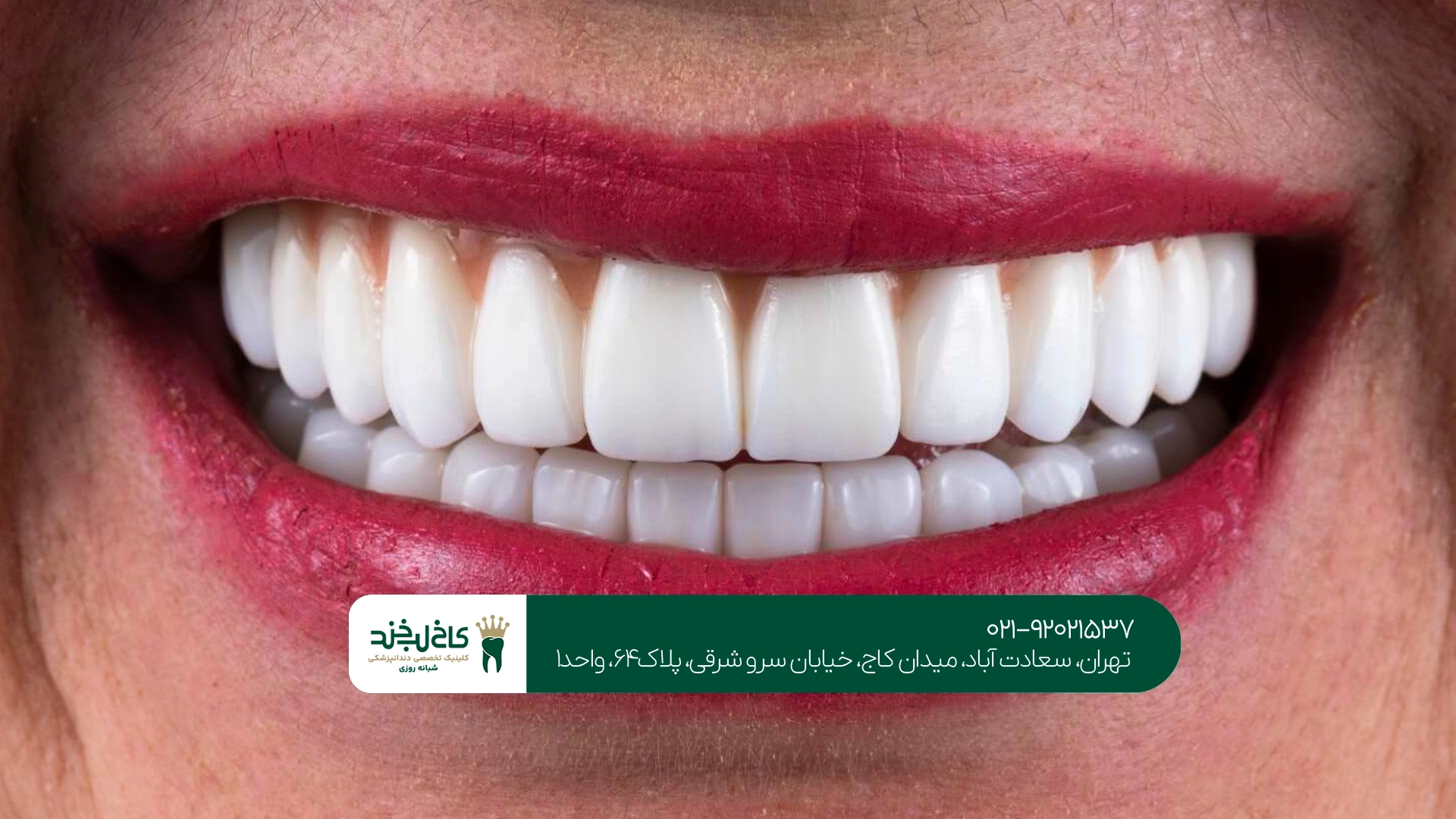 ونیر کامپوزیت فوری در تهران