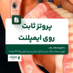 پروتز ثابت روی ایمپلنت