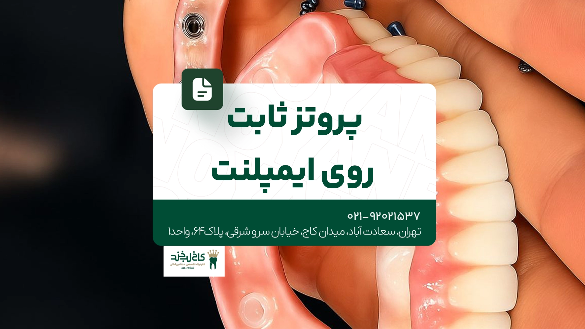 پروتز ثابت روی ایمپلنت