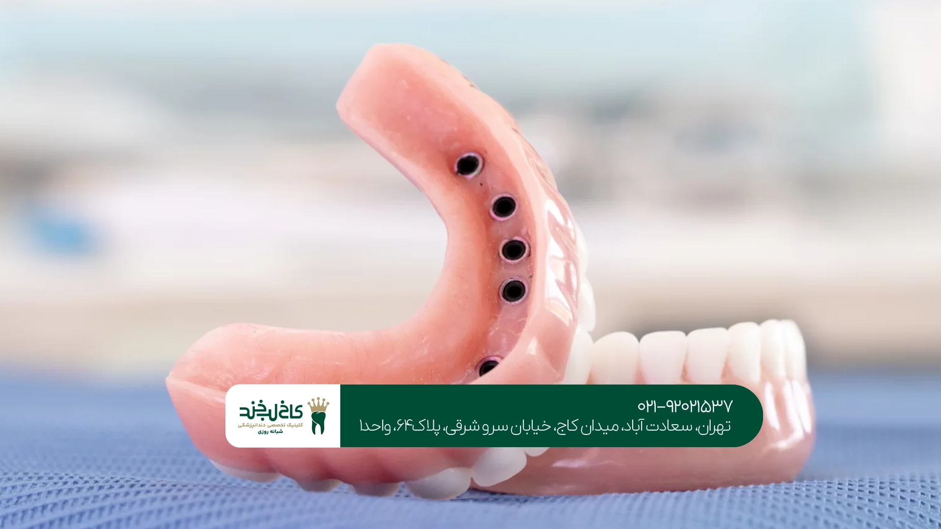 مزایای پروتز ثابت روی ایمپلنت چیست؟
