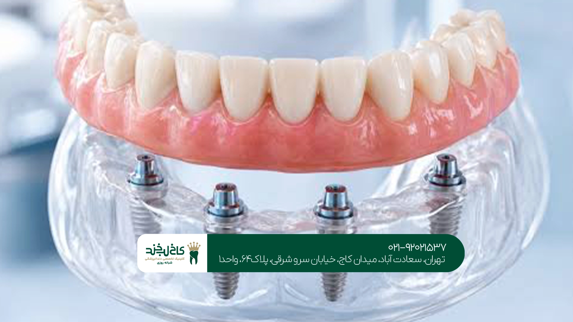 پروتز دیجیتال در تهران