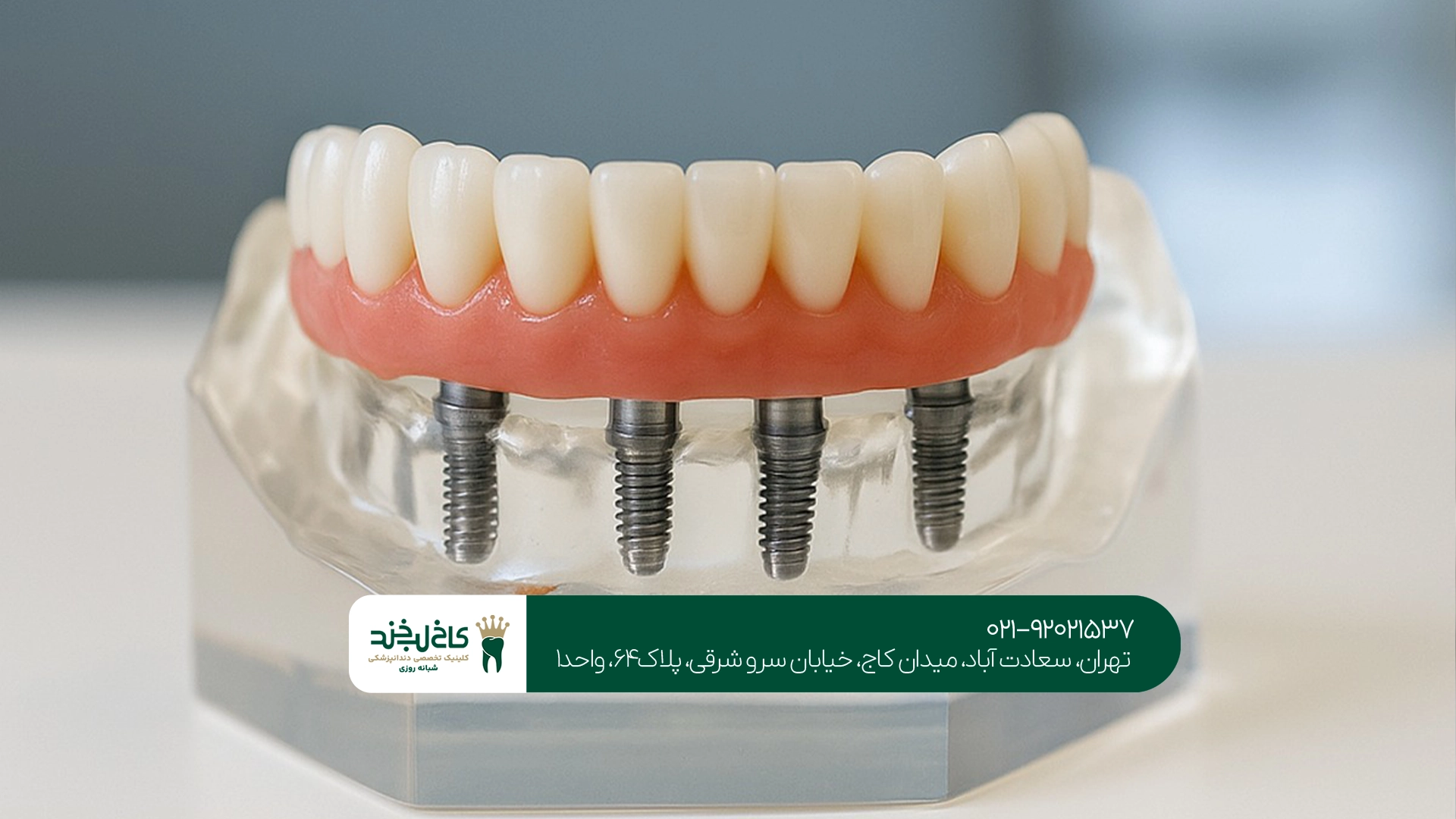 عمر پروتز دیجیتال چقدر است؟