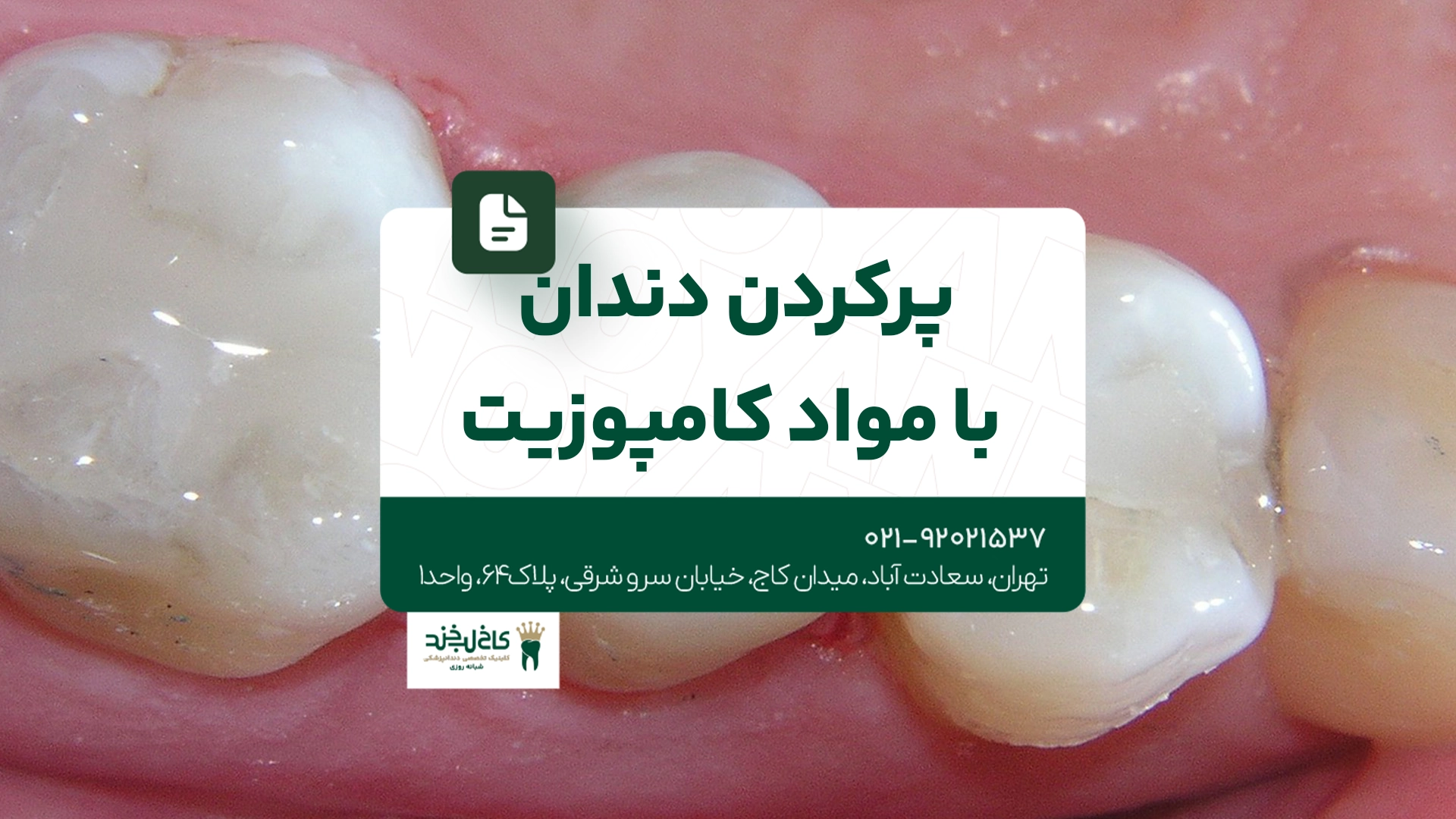 پر کردن دندان با کامپوزیت پر کردن دندان با کامپوزیت