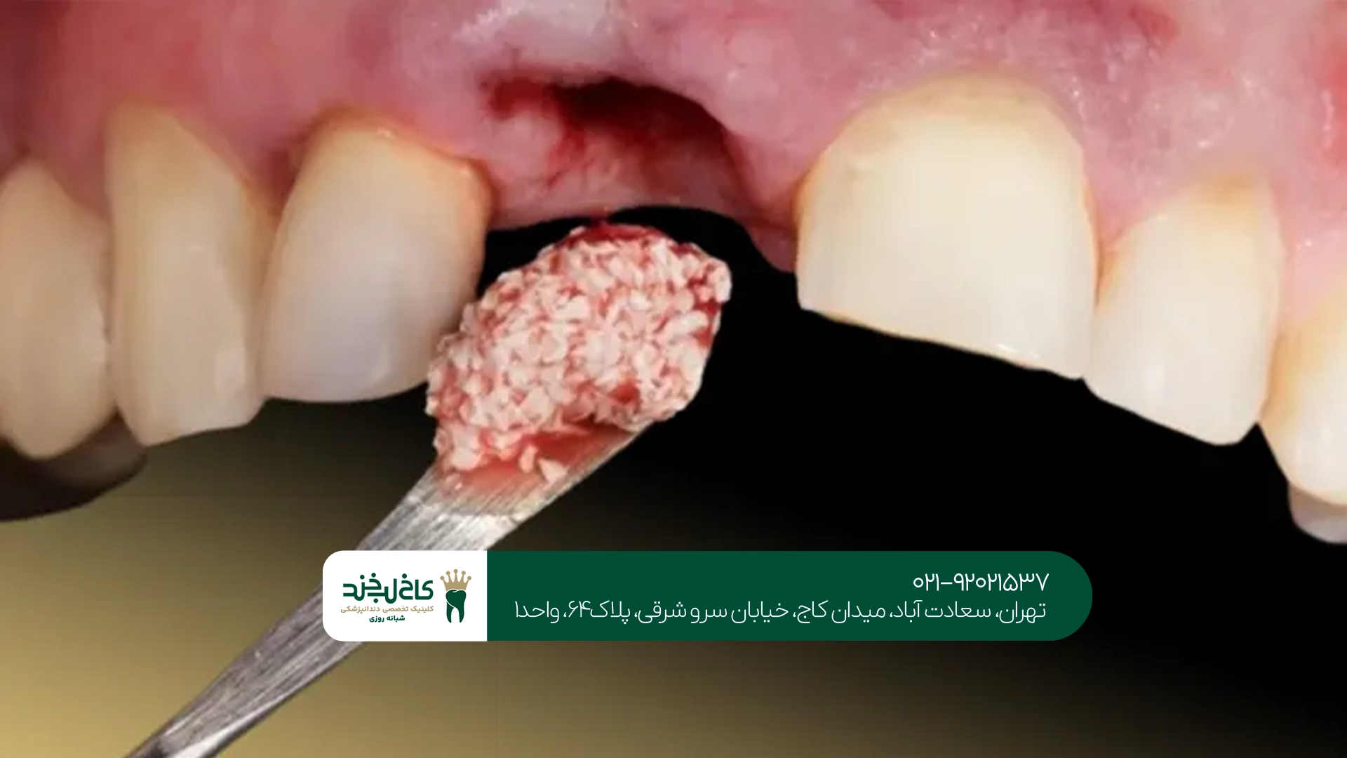 بهترین مرکز پیوند استخوان برای ایمپلنت