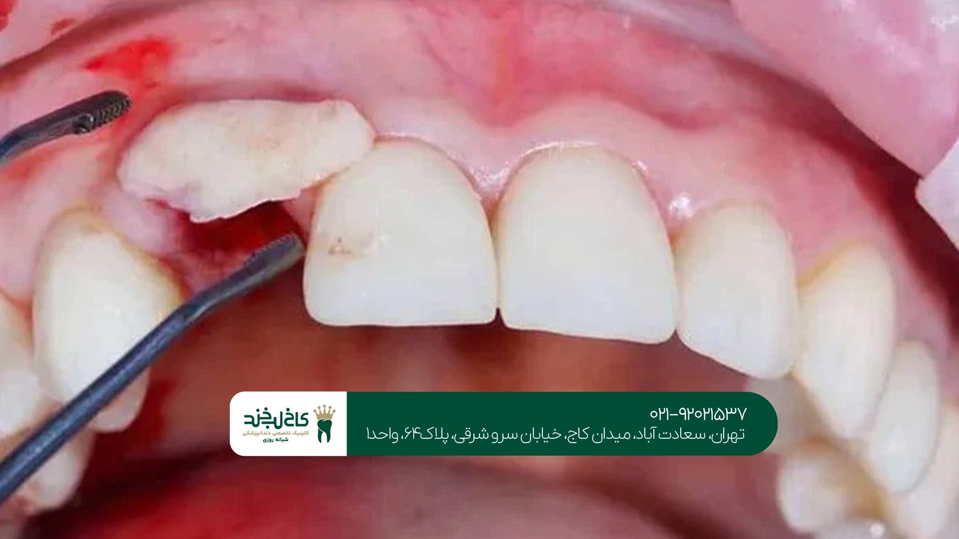 بهترین متخصص پیوند استخوان فک