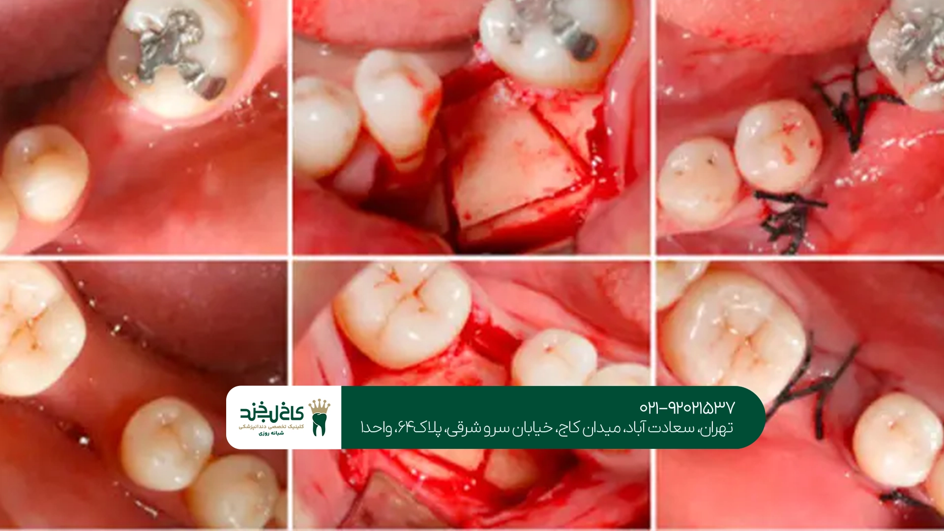 پیوند استخوان دندان چقدر زمان میبرد؟