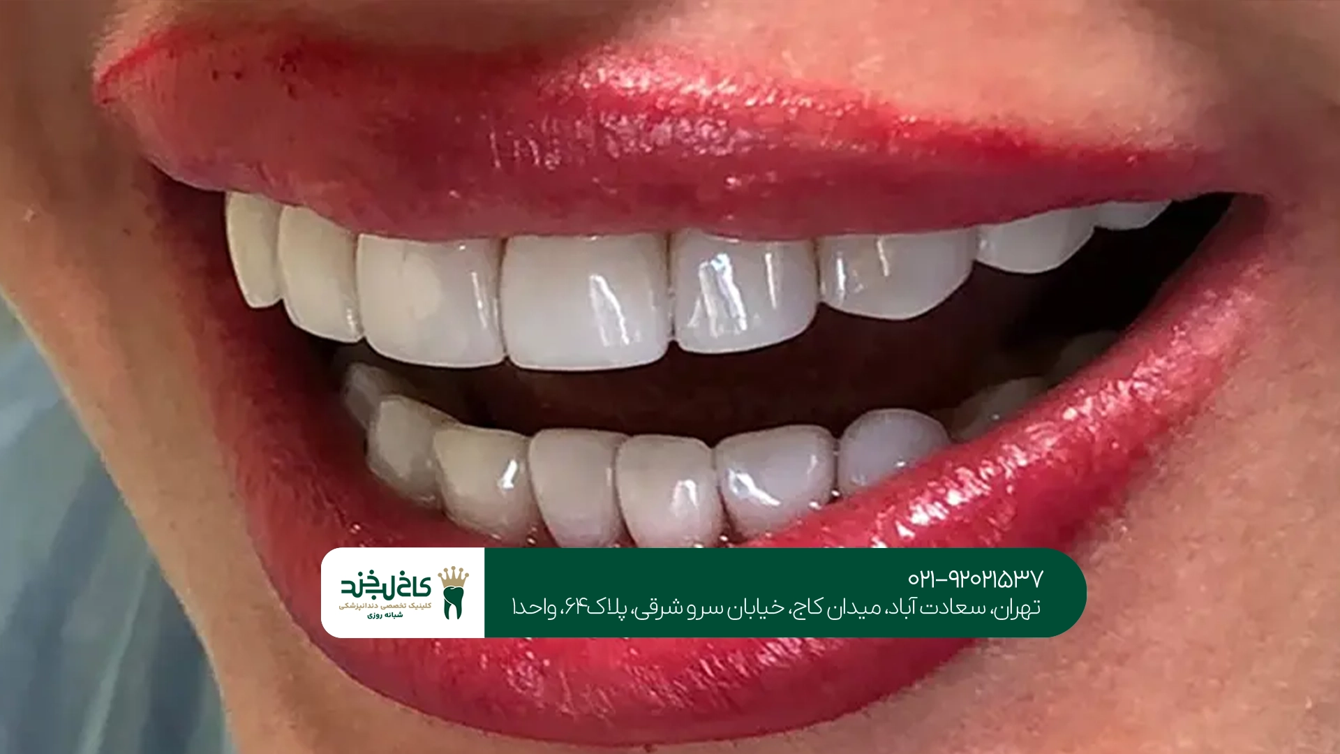دندانپزشکی کامپوزیت اقساطی تهران