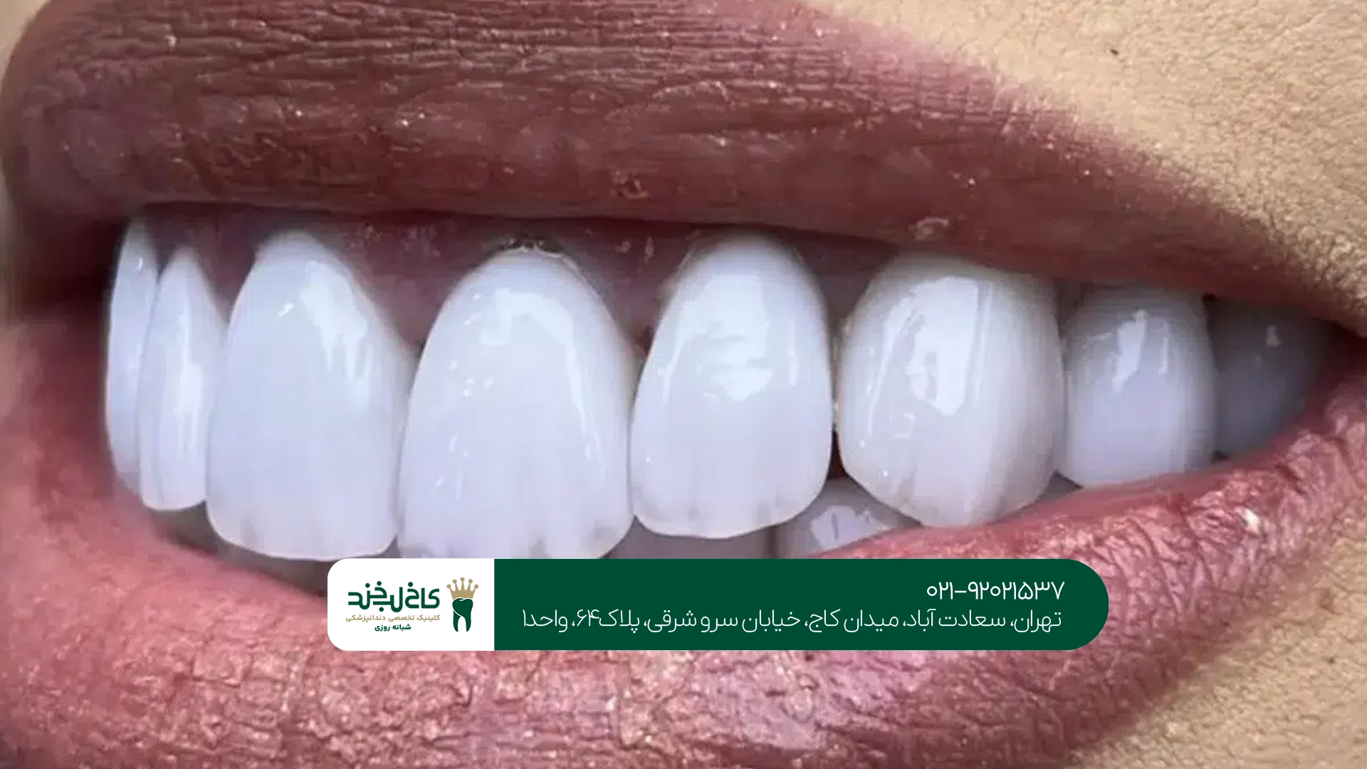 چگونه بهترین دندانپزشک برای کامپوزیت اقساطی را انتخاب کنیم؟