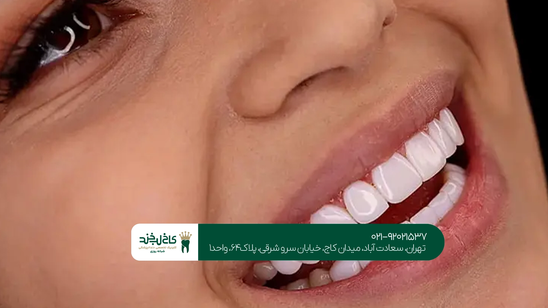 مزایای انجام کامپوزیت دندان به صورت اقساطی