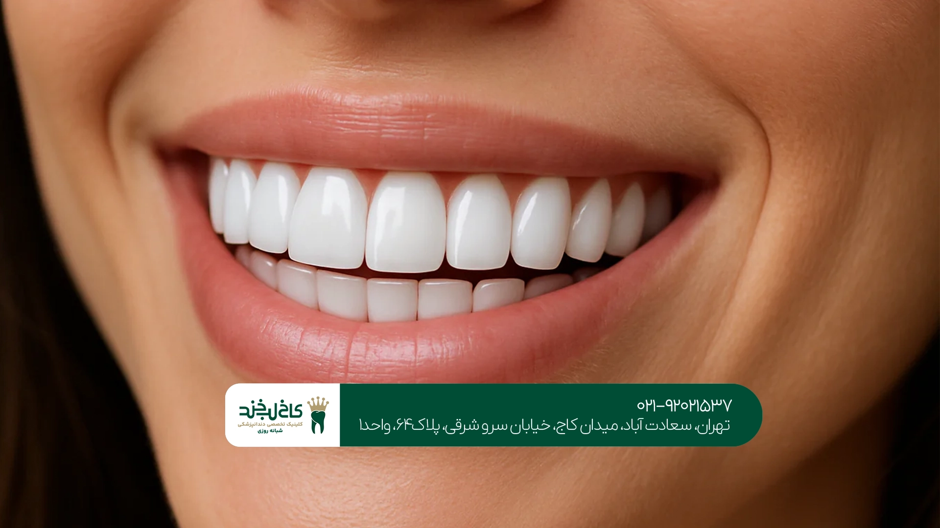 کامپوزیت اقساطی