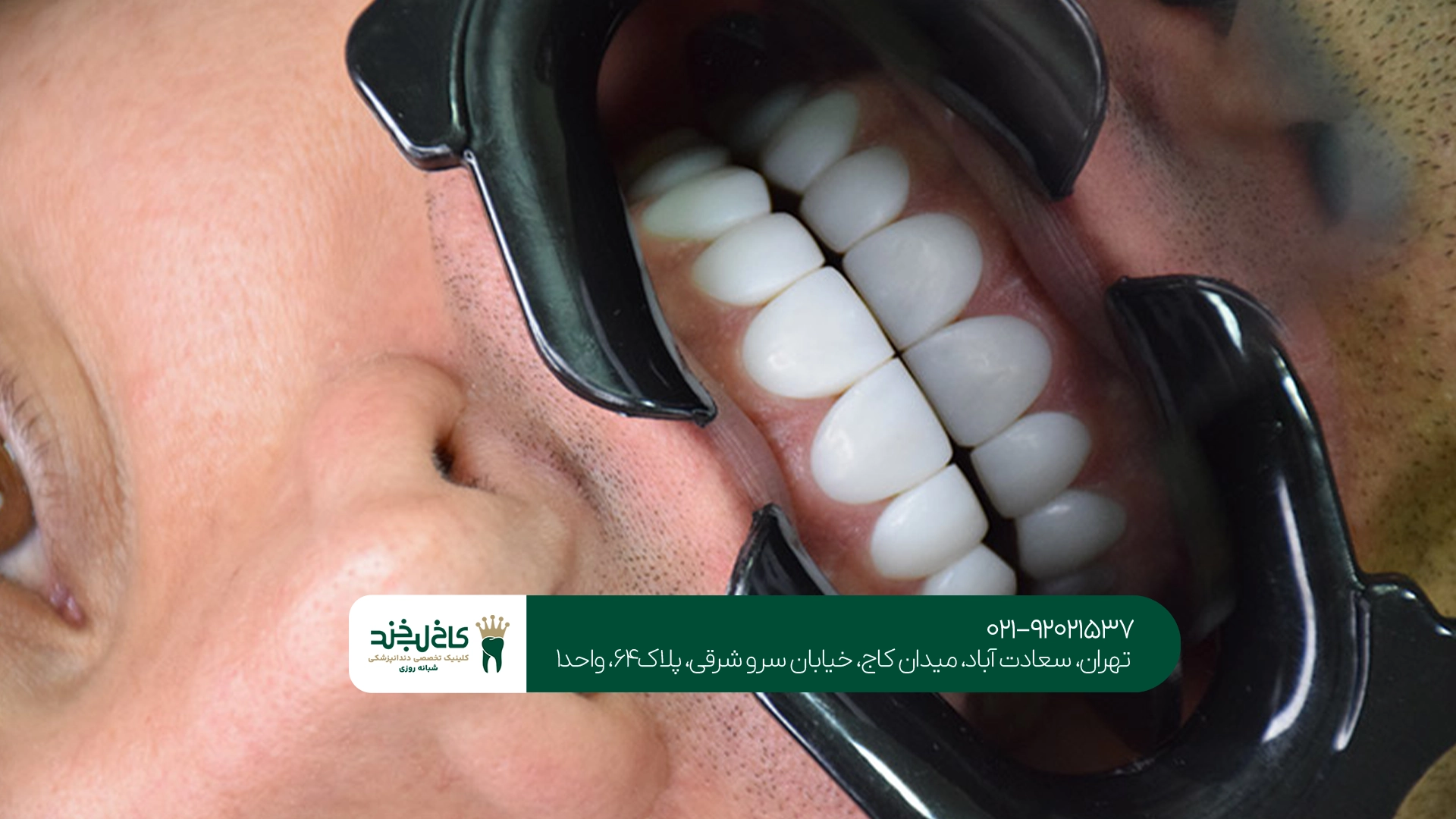 کامپوزیت بدون تراش طبیعی