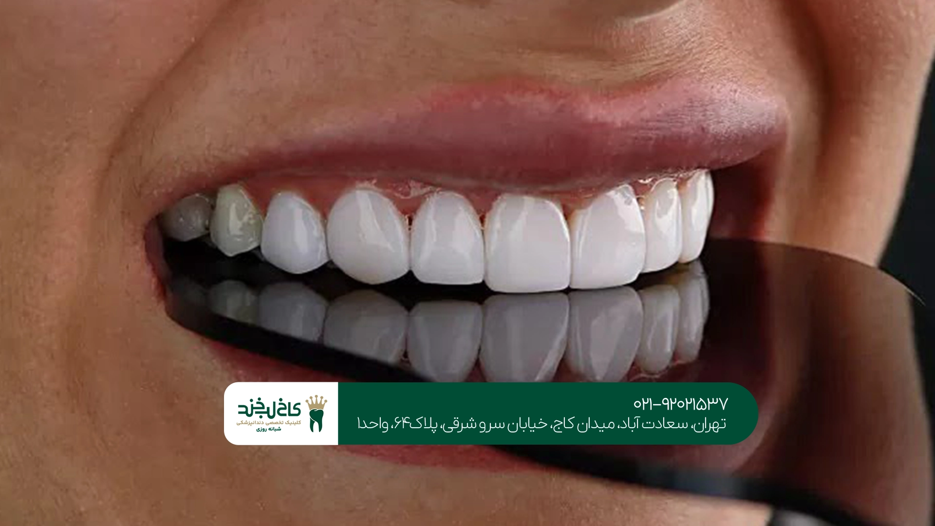 مزایا و معایب کامپوزیت بدون تراش
