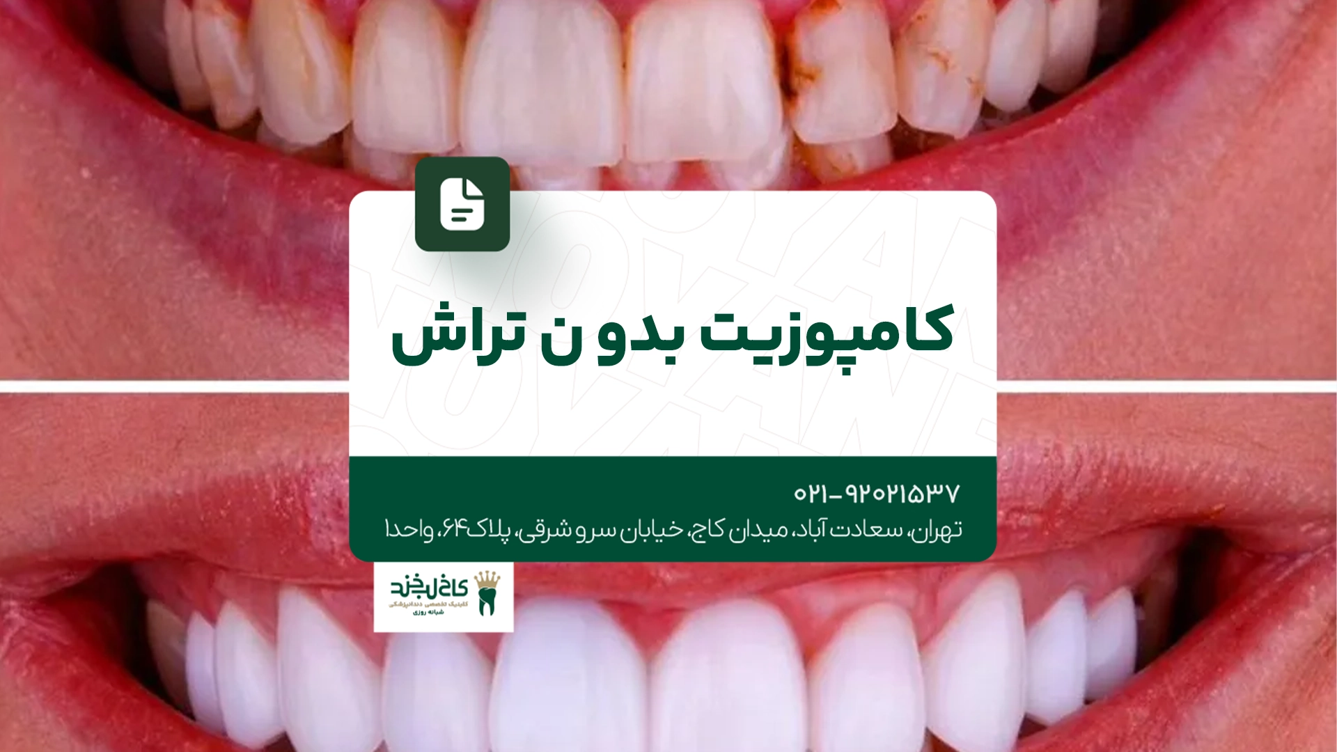 کامپوزیت بدون تراش
