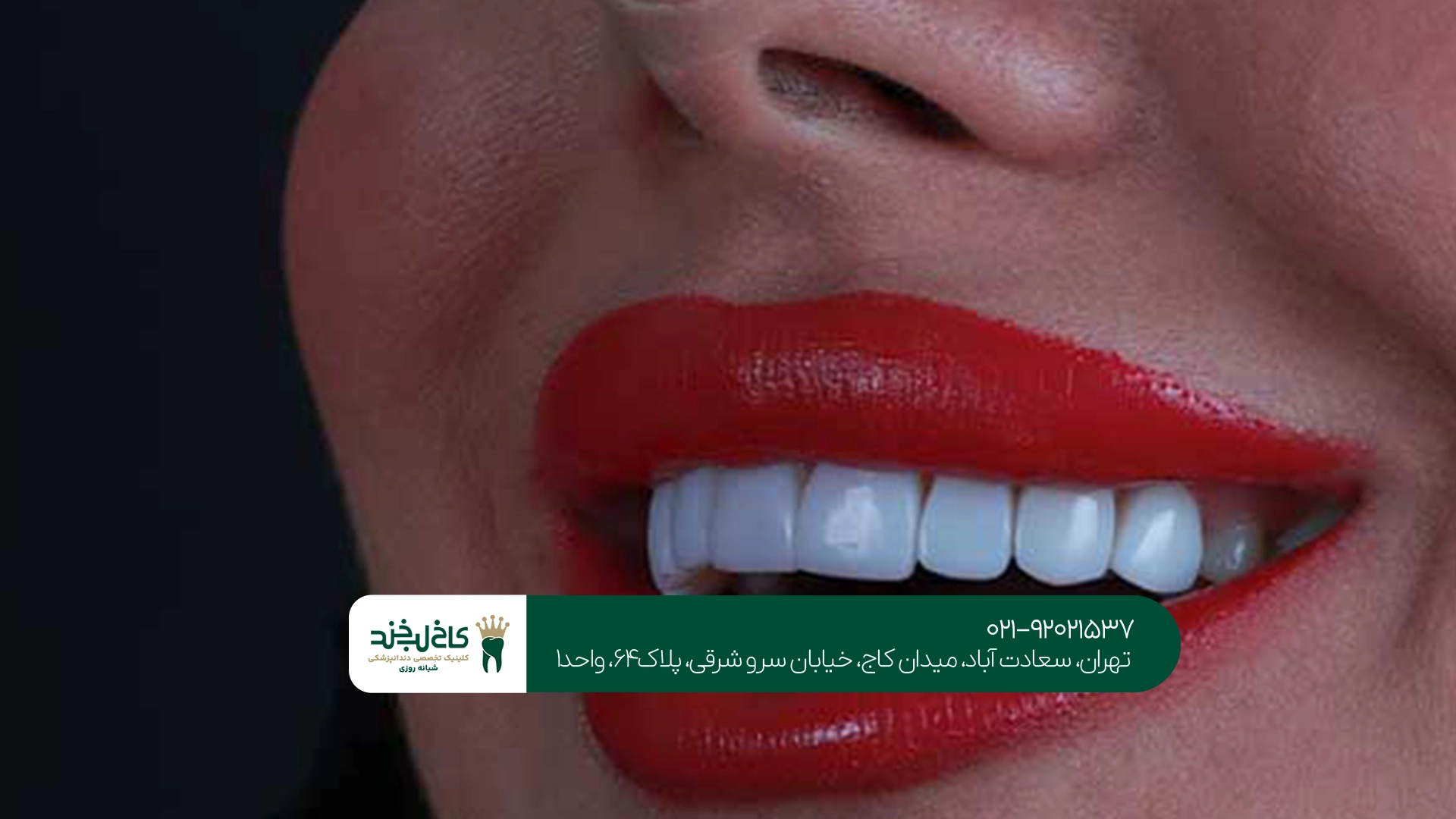 کامپوزیت دندان دیجیتال تهران