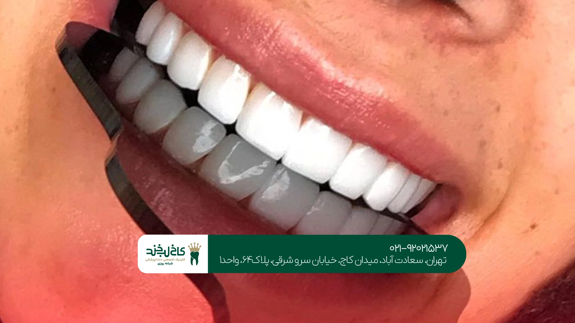 مراقبتهای بعد از کامپوزیت دندان چگونه است؟