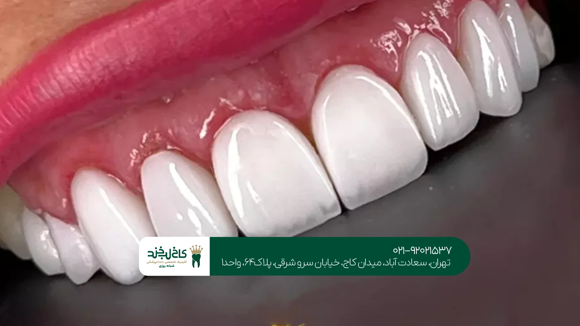 ماندگاری کامپوزیت دندان چقدر است؟