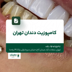 کامپوزیت دندان تهران