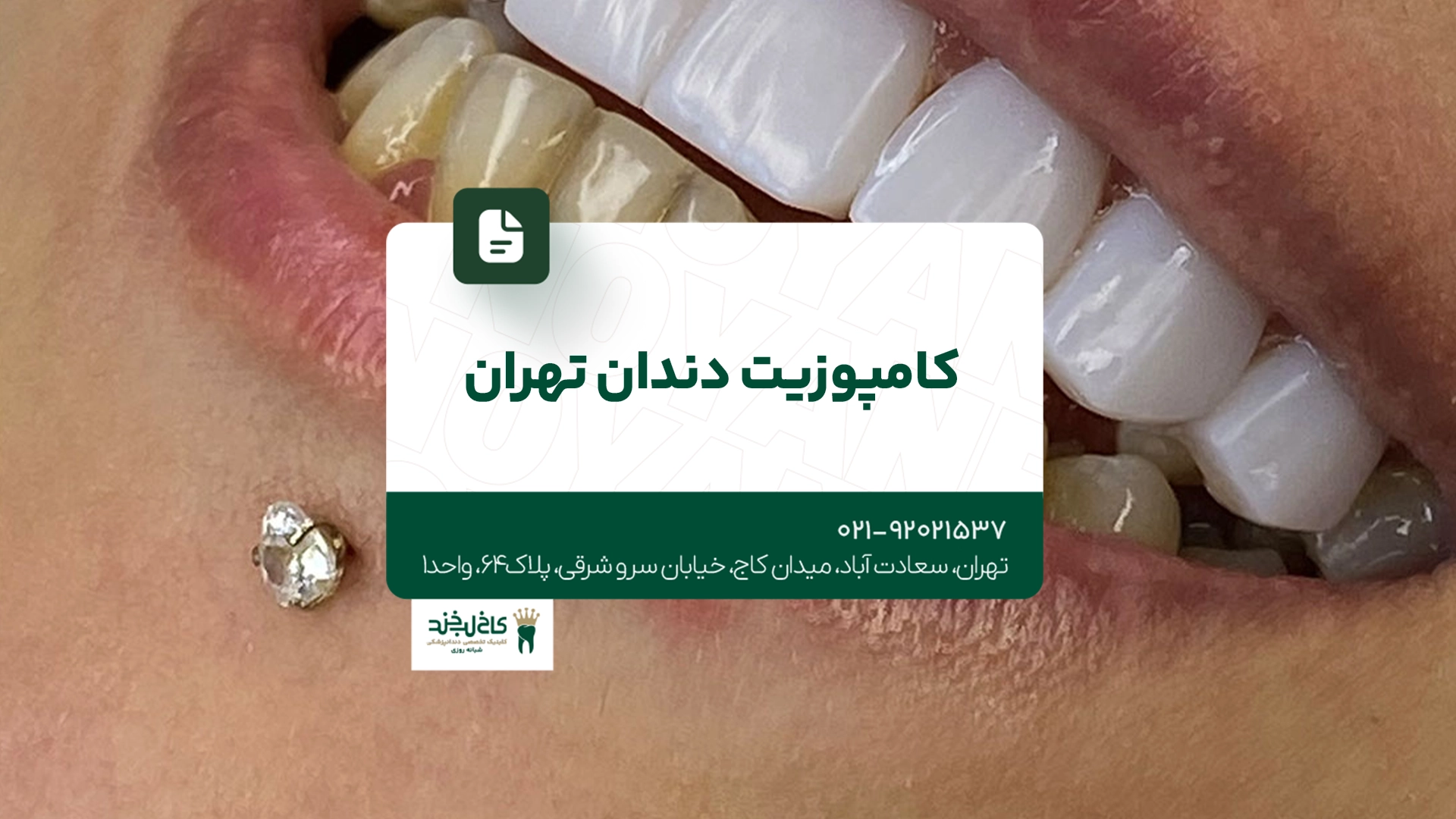 کامپوزیت دندان تهران
