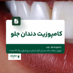کامپوزیت دندان جلو